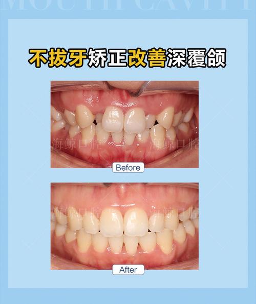 佳木斯矫正牙齿多少钱？效果和医院怎么选？-图1