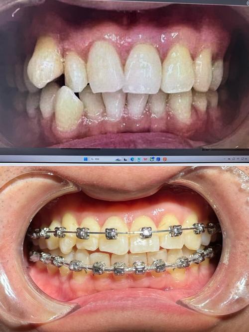 华西医院矫正牙齿效果如何？价格贵吗？流程复杂吗？-图1