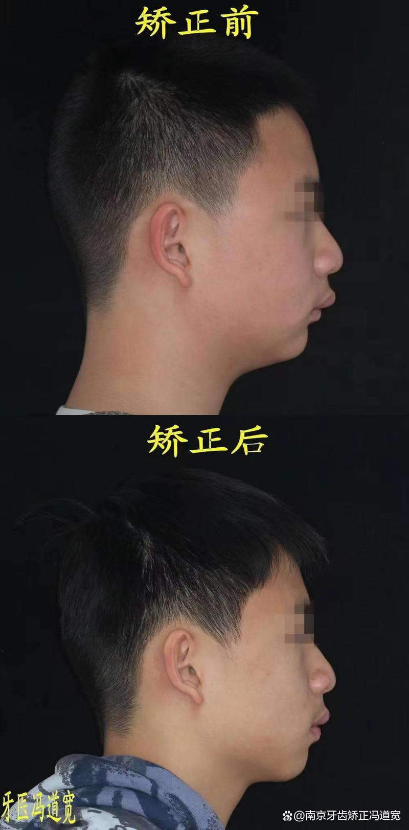 南京成人牙齿矫正，多久能排齐？选哪家医院好？-图3