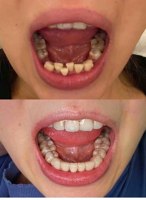 合肥隐形矫正牙齿效果咋样？价格贵不贵？医院怎么选？-图2