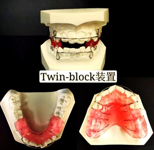 功能性牙齿矫正器，与传统矫正有何不同？-图1