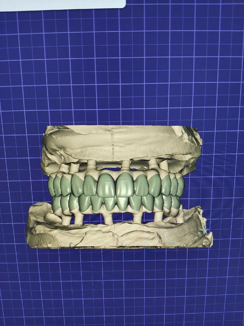 3d牙齿矫正技术-图2