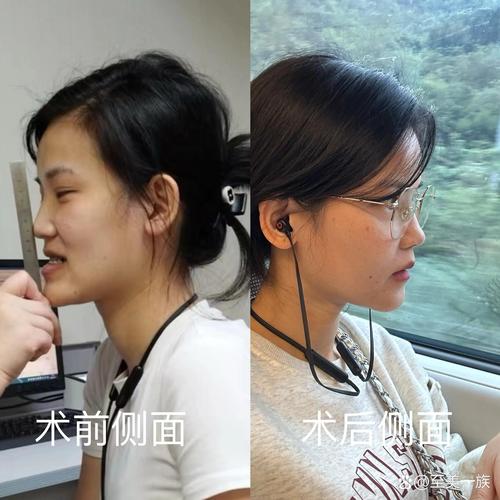 牙齿地包天矫正后-图1 牙齿地包天矫正后-图1