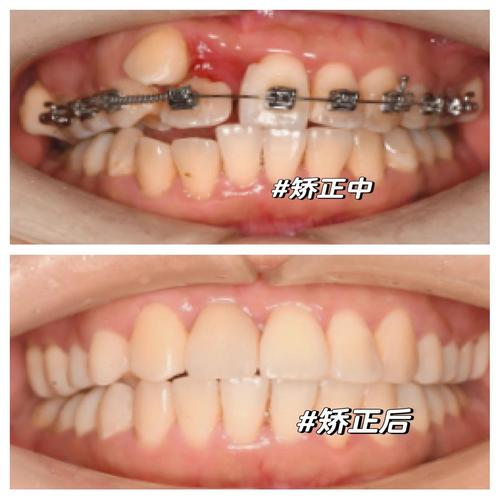 虎牙能矫正吗？矫正方法与效果解析-图3