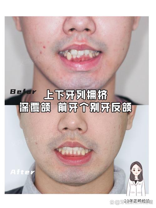 矫正牙齿不想拔牙，有哪些替代方案？-图2