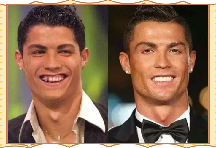 明星拔牙矫正牙齿-图1 明星拔牙矫正牙齿-图1