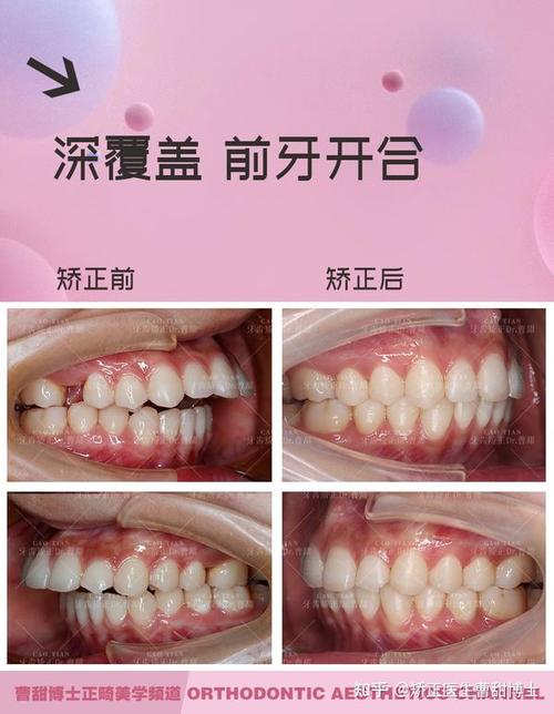 厦门牙齿矫正前后，变化究竟有多大？-图3
