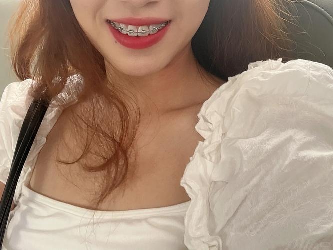 在合肥做牙齿矫正-图1