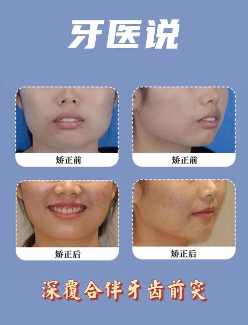 矫正牙齿脸型对比-图2