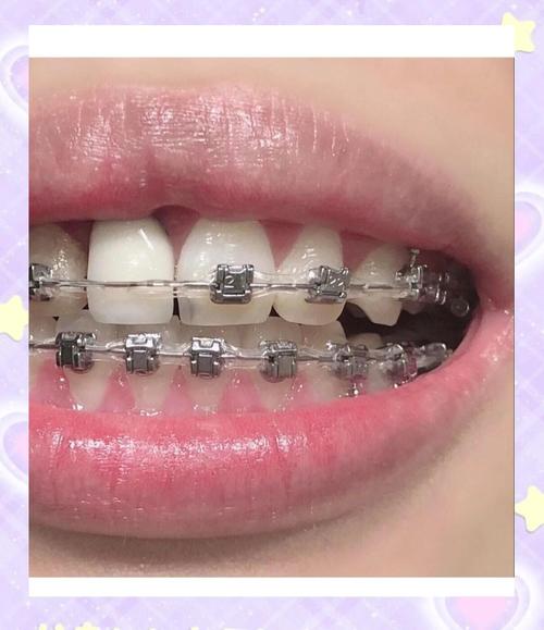 牙齿矫正戴橡皮圈-图2