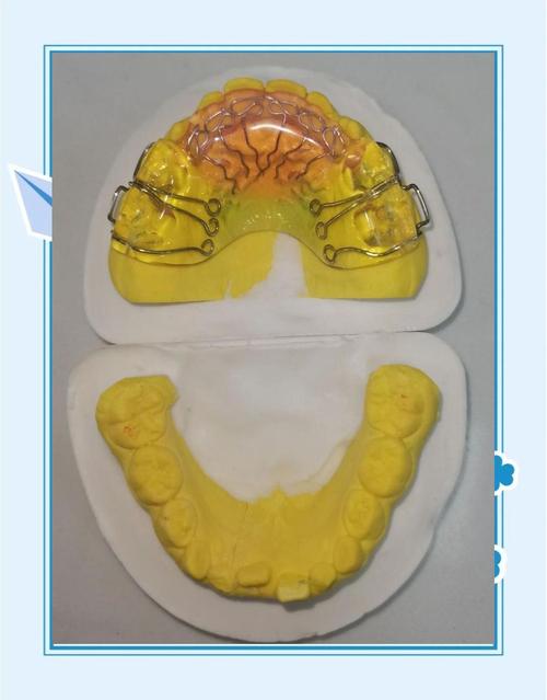 牙齿矫正器有哪几种？不同类型怎么选？-图2