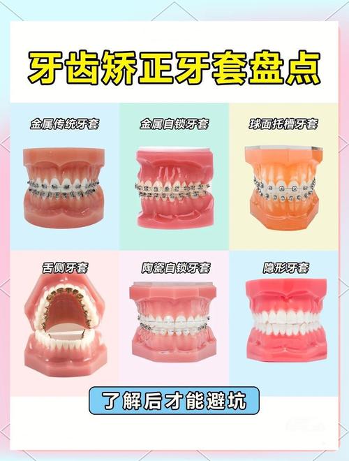 牙齿矫正器有哪几种？不同类型怎么选？-图3