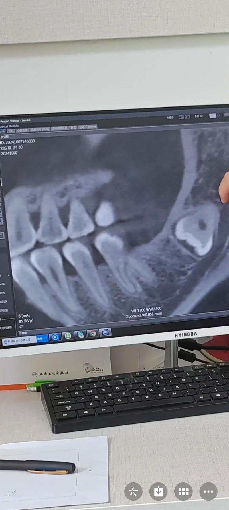 矫正牙齿后长智齿-图2