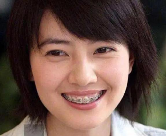 哪些明星悄悄矫正过牙齿？-图3