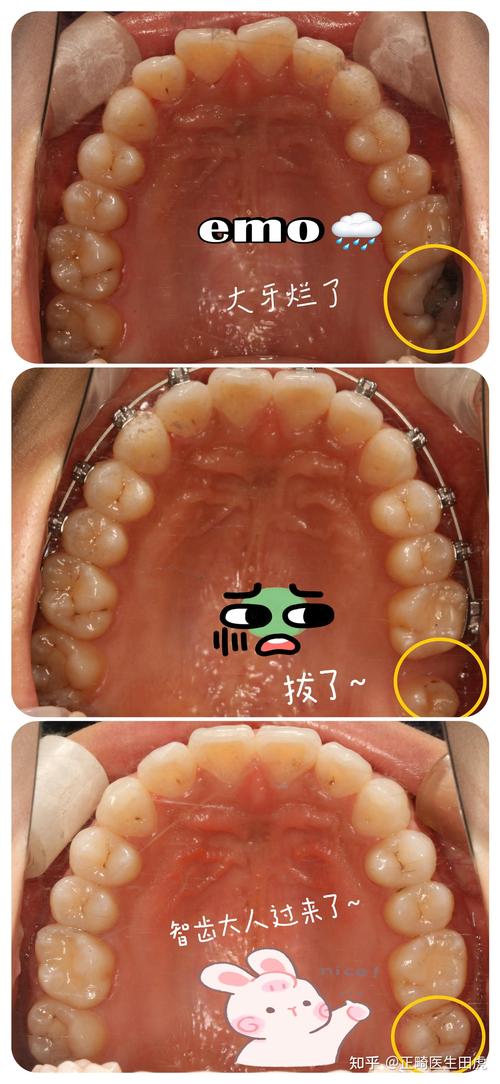 矫正牙齿前的拔牙-图2 矫正牙齿前的拔牙-图2