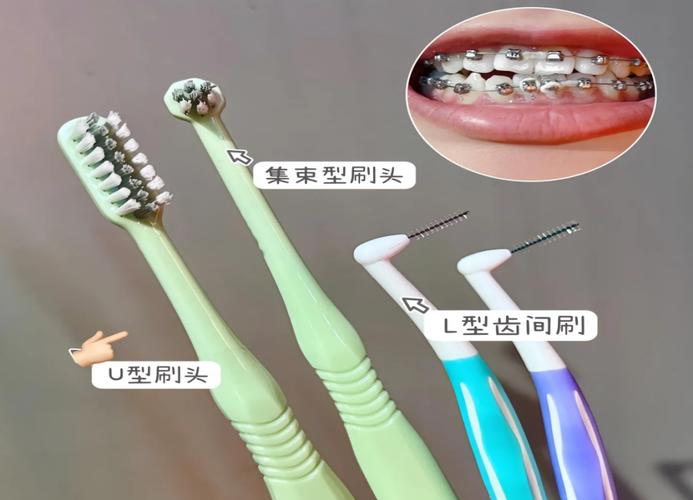 矫正牙齿期间能正常刷牙吗？-图2