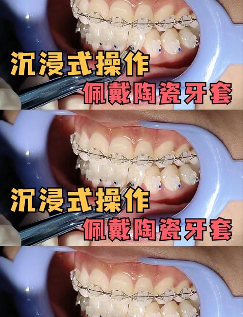 牙齿矫正陶瓷牙套-图1