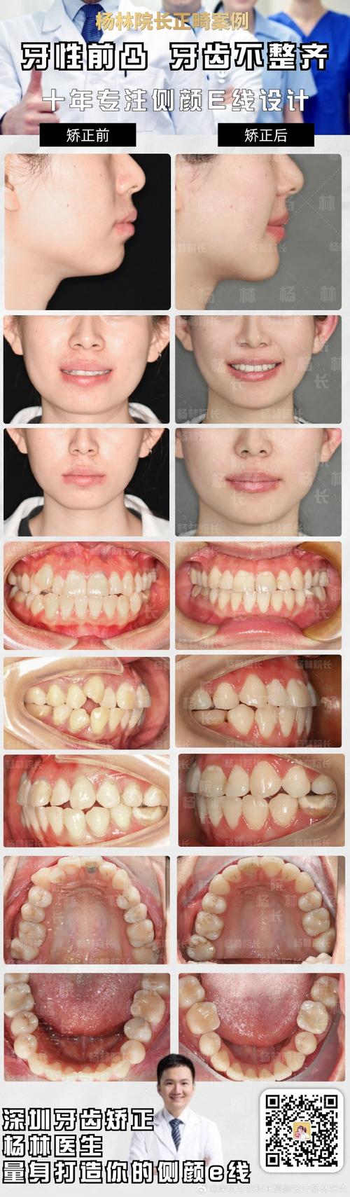 矫正牙齿为何会引发牙敏感？如何有效缓解？-图2