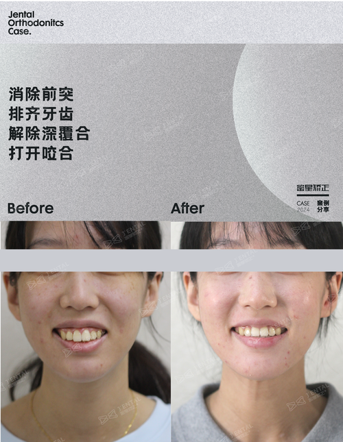 拔八颗牙矫正牙齿-图1
