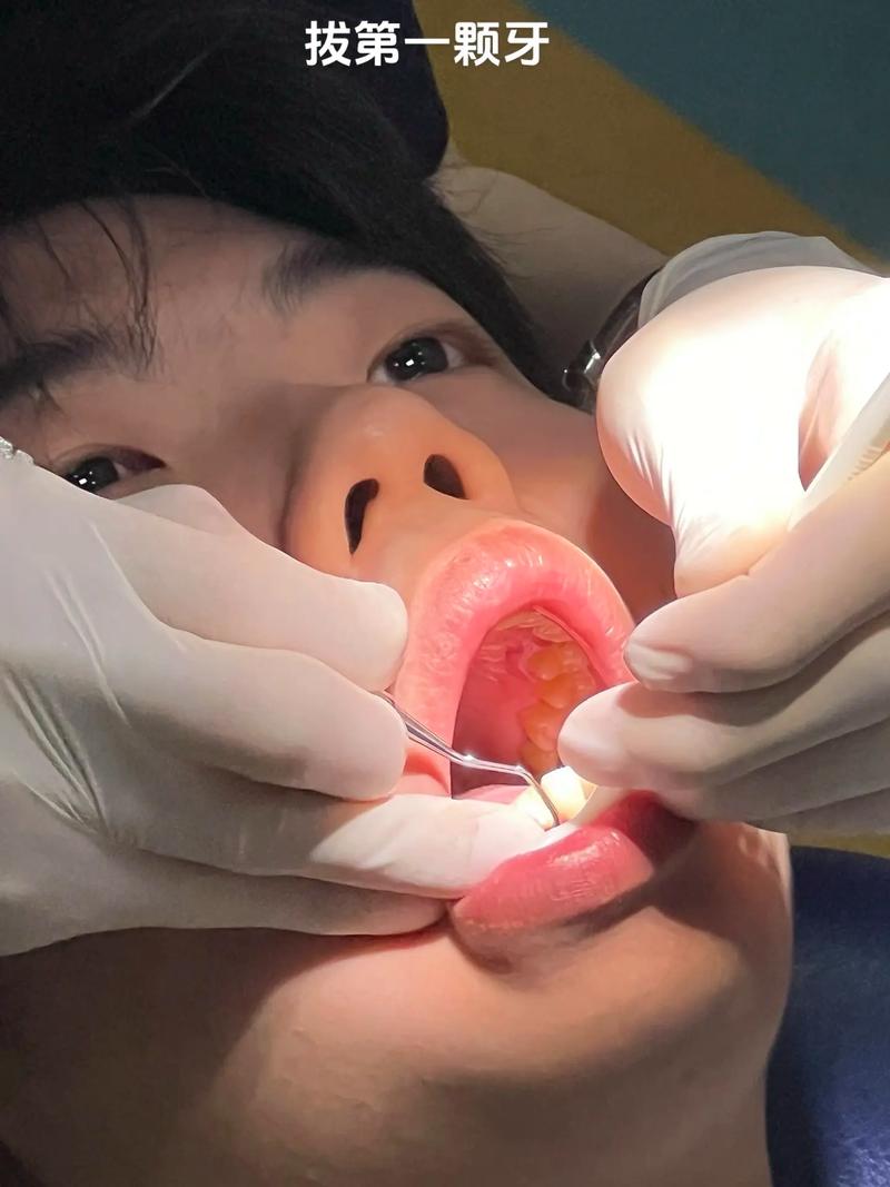 拔八颗牙矫正牙齿-图3