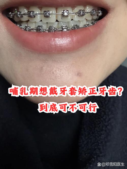 哺乳期做牙齿矫正，宝宝安全吗？-图1