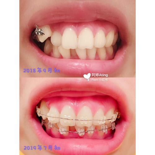 牙齿矫正下排牙齿-图3