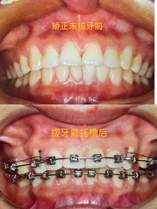 矫正牙齿拔智齿吗-图1