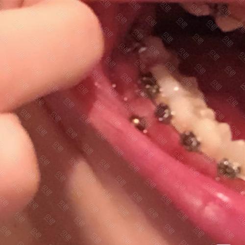 矫正托槽掉了要紧吗？该怎么紧急处理？-图3