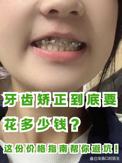 22岁牙齿矫正吗-图2