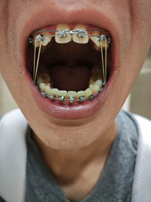 22岁牙齿矫正吗-图3