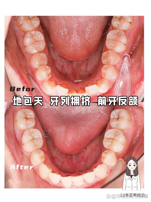 矫正牙齿咬合不齐,效果如何?能恢复正常吗?-图2 矫正牙齿咬合不齐,效果如何?能恢复正常吗?-图2