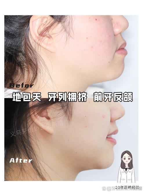 矫正牙齿咬合不齐,效果如何?能恢复正常吗?-图3 矫正牙齿咬合不齐,效果如何?能恢复正常吗?-图3