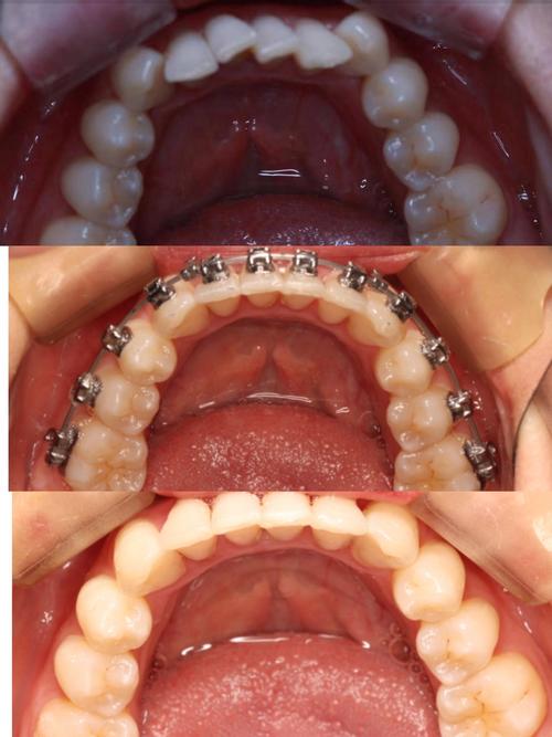 牙齿矫正上牙可以-图2