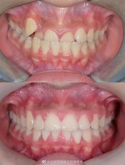 牙齿后咬合矫正有哪些有效方法？-图1