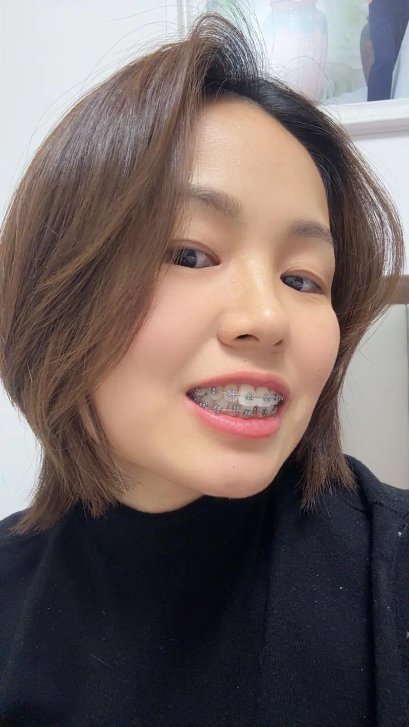 31岁矫正牙齿，现在开始还来得及吗？-图2