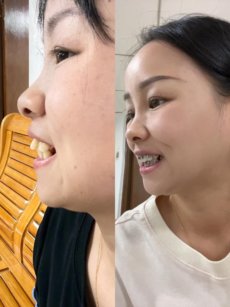 牙齿矫正如何影响脸型变化？-图2
