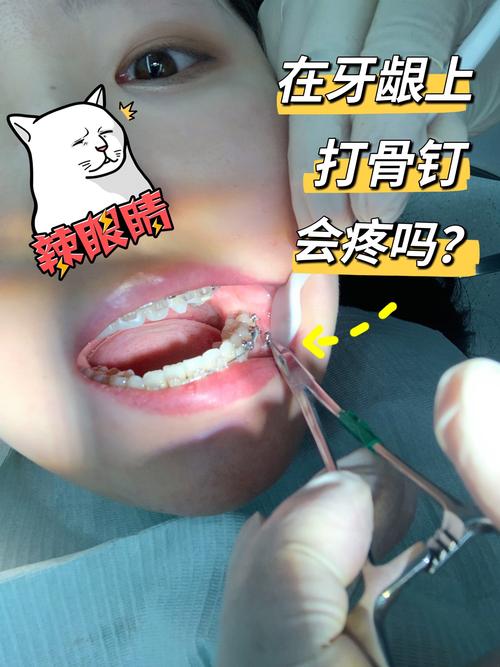 矫正牙齿为啥要打钉子？种植钉到底有啥用？-图1