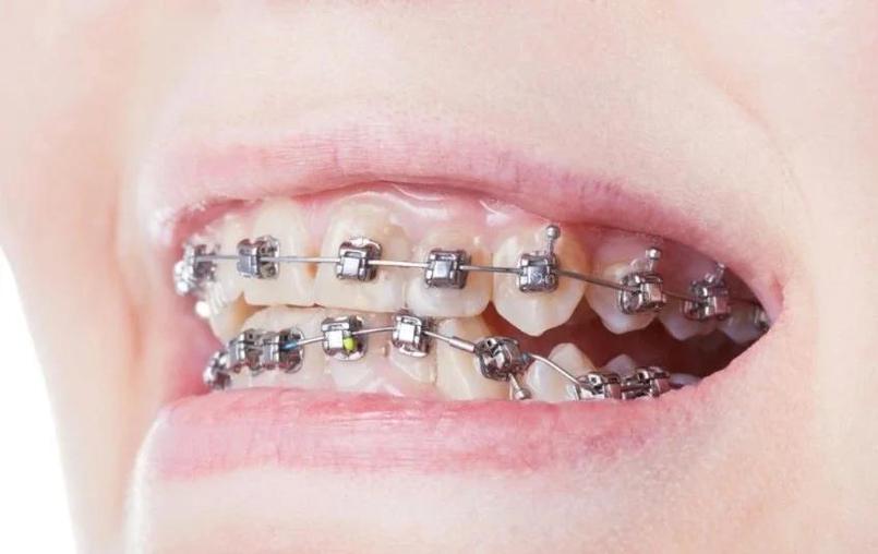 矫正牙齿隐形托槽-图3 矫正牙齿隐形托槽-图3