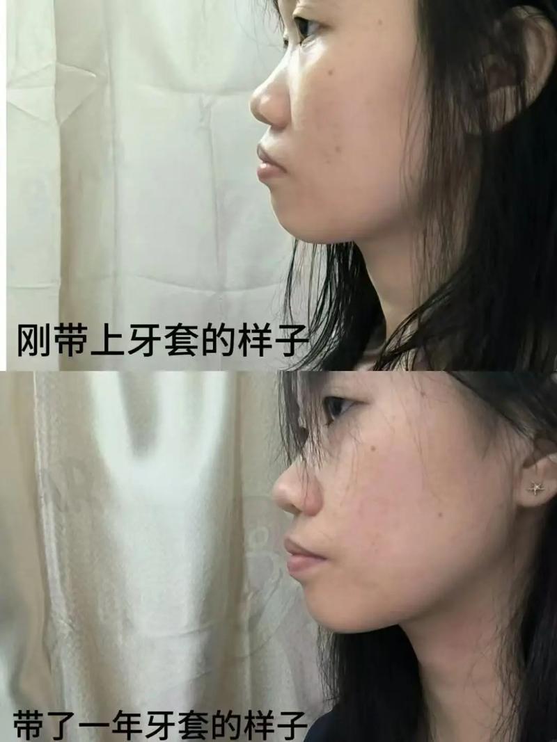 矫正牙齿脸会变吗-图1 矫正牙齿脸会变吗-图1