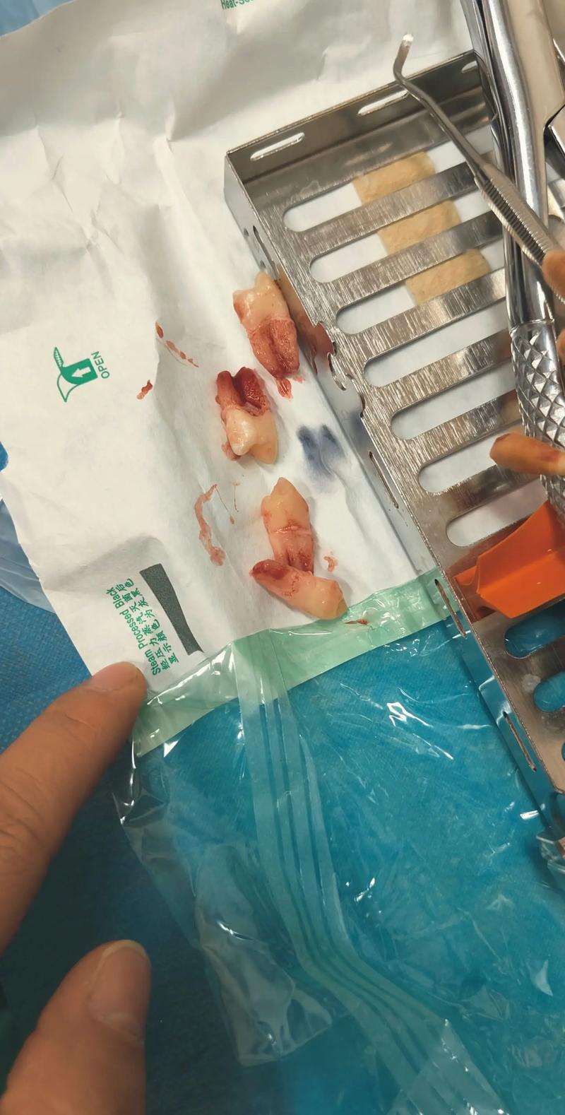 牙齿矫正拔一颗牙-图3