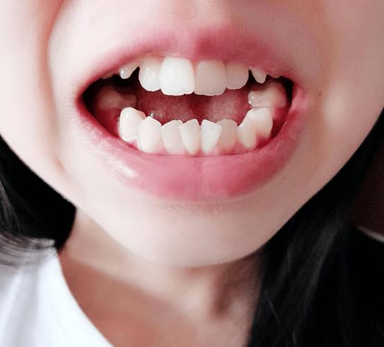 最便宜的矫正牙齿安全吗？效果能保证吗？-图2