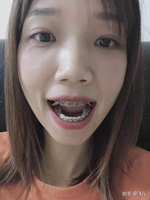 29岁矫正牙齿晚不晚?成年人矫正要注意啥?-图2 29岁矫正牙齿晚不晚?成年人矫正要注意啥?-图2