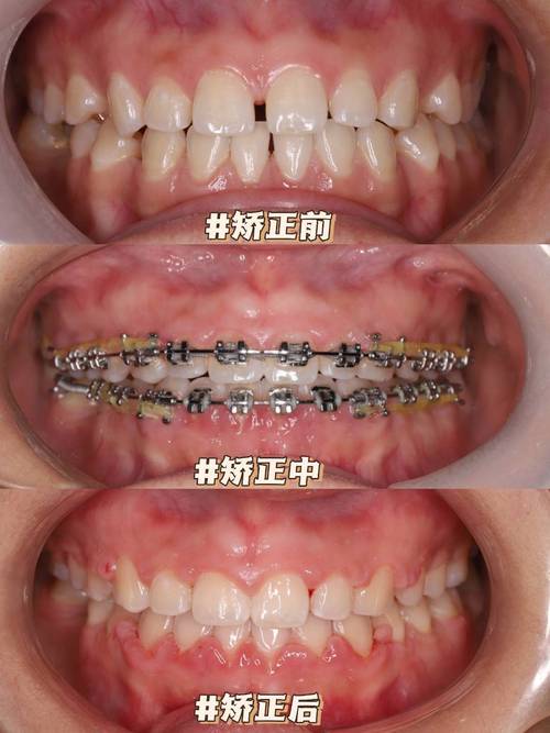 三甲医院矫正牙齿，效果比普通医院更好吗？-图1