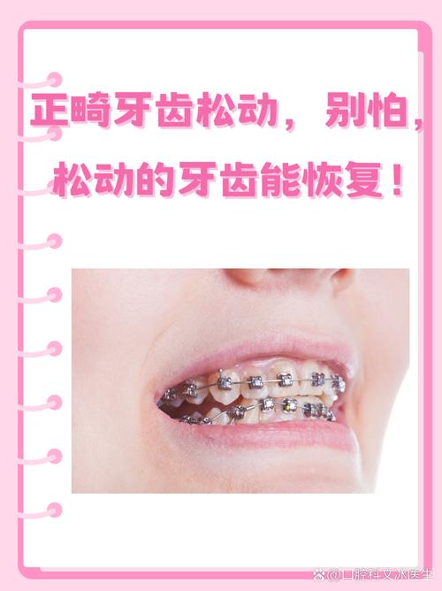 矫正牙齿会导致牙齿松动吗？矫正过程中松动该怎么办？-图1