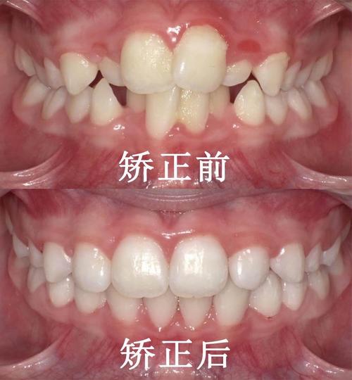 儿童牙齿的矫正吗-图2