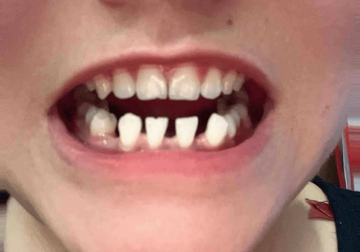 矫正牙齿牙齿稀疏-图1