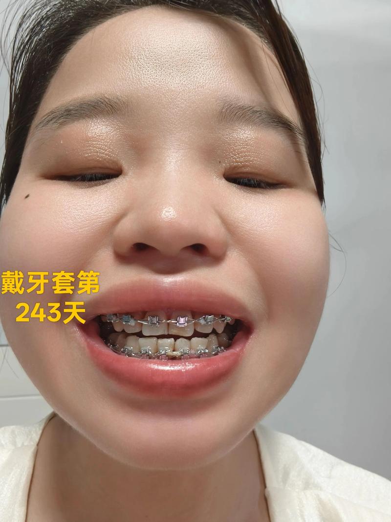 40岁矫正牙齿，晚不晚？效果会打折扣吗？-图2
