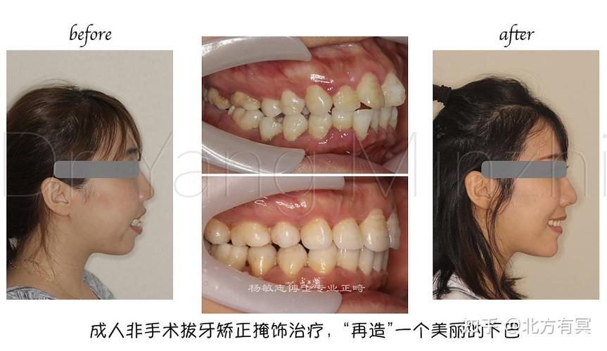 牙齿矫正非得拔4颗牙吗？会有什么影响？-图2