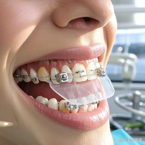 30岁矫正牙齿还来得及吗？效果会比年轻人差吗？-图1