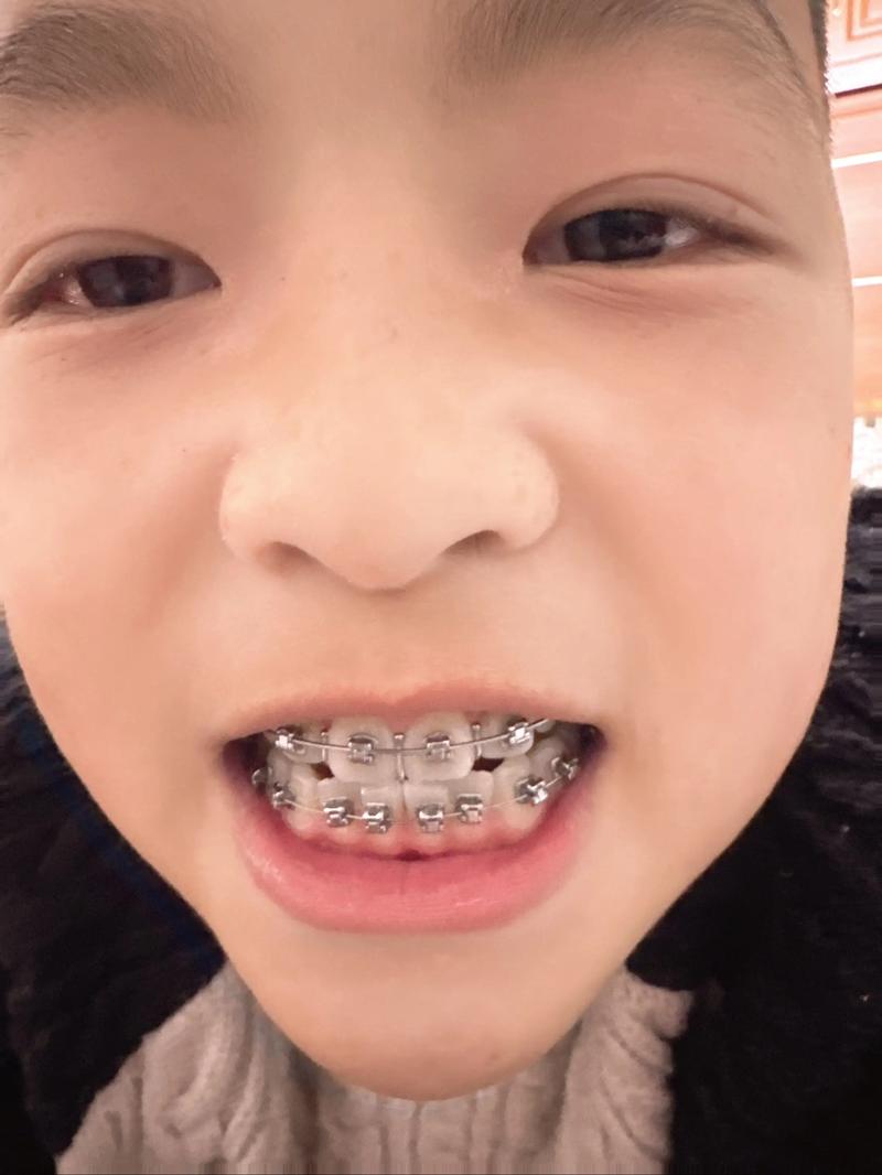 辽宁沈阳牙齿矫正-图2